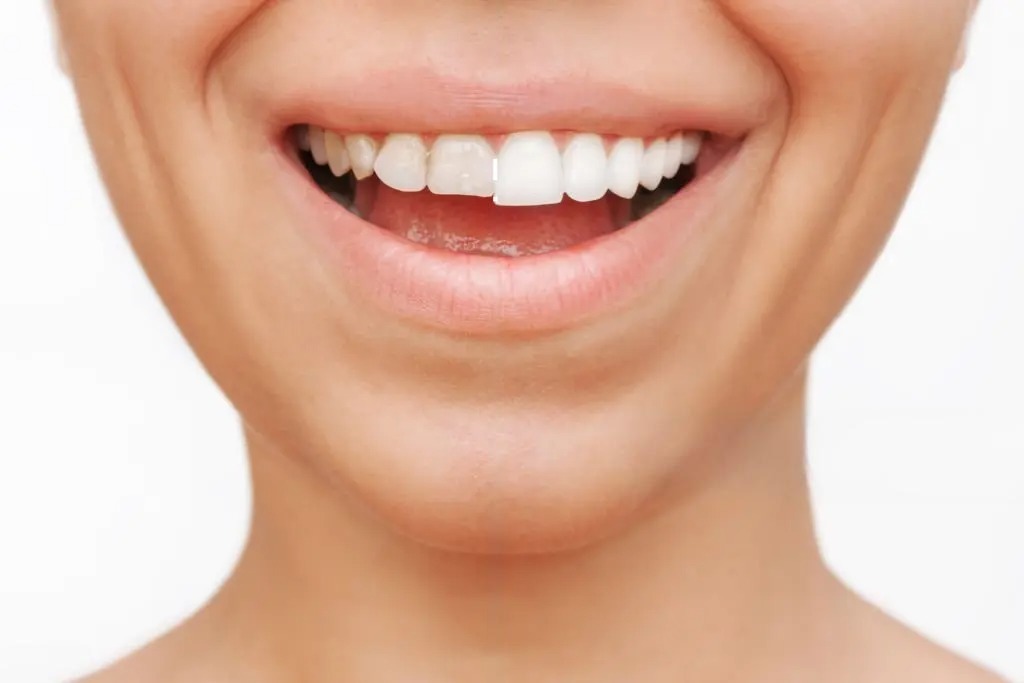 Carillas dentales en Valencia